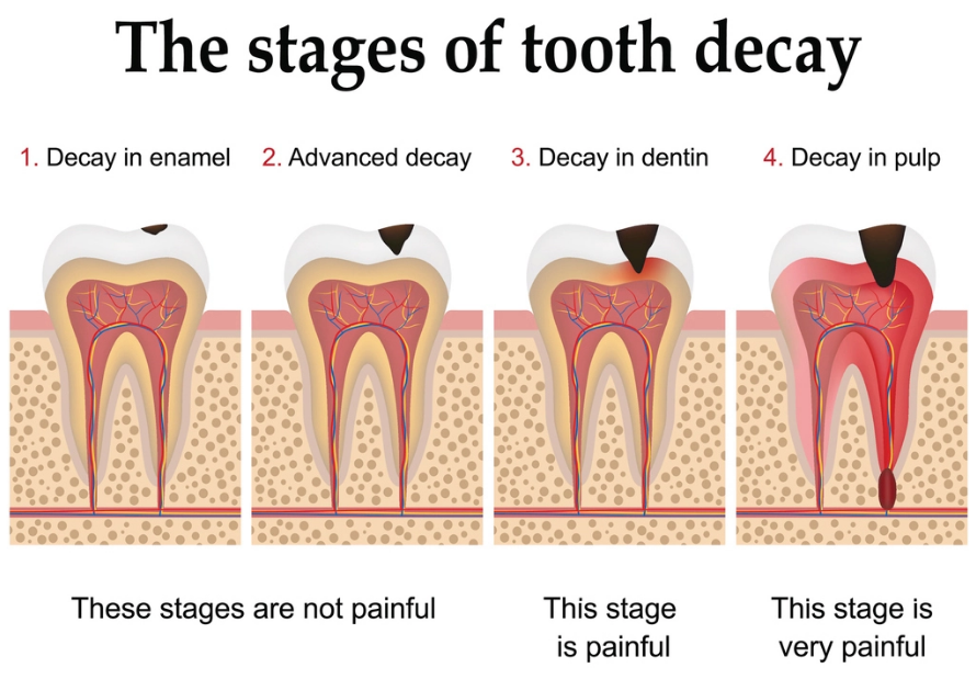 What causes tooth decay? | The Financial Express