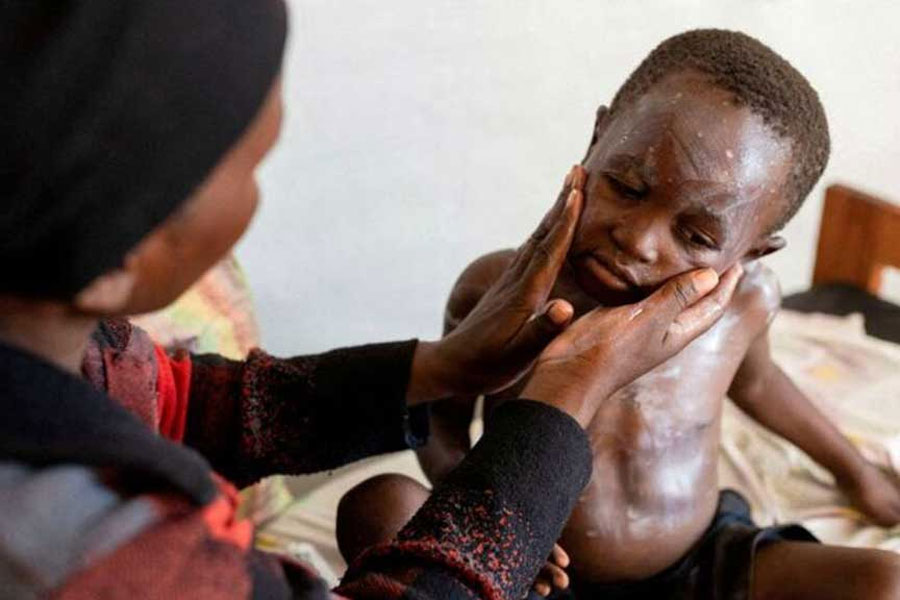 Furaha Elisabeth applies medication on the skin of her child Sagesse Hakizimana who is under treatment against Mpox, an infectious disease caused by the Mpox virus that causes a painful rash, enlarged lymph nodes and fever, at a health centre in Munigi, Nyiragongo territory, near Goma in North Kivu province of the Democratic Republic of Congo August 19, 2024.